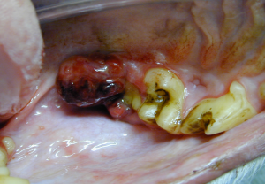 Malignant melanoma adjacent to the maxillary second molar tooth